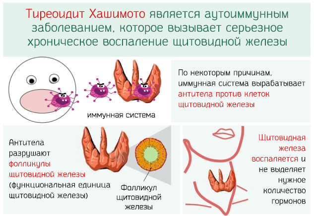 Повышены антитела к ТПО / антитела к ТТГ – что делать?