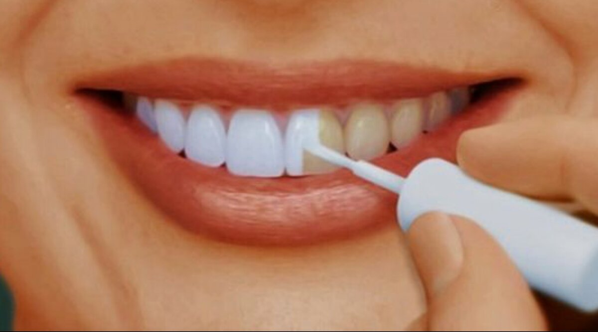 Как можно отбелить зубы в домашних условиях. Отбеливание зубов. Покрытие зубов фторлаком. Стоматологическая краска для зубов.
