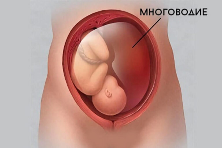 Как выглядит многоводие у беременной в картинке