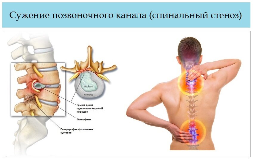 Лечение абсолютного стеноза позвоночного канала. Стеноз межпозвонковых отверстий l2-s1. Стеноз спинномозгового канала поясничного отдела позвоночника. Спинальный стеноз с6-с7. Стеноз позвоночного канала рентген признаки.