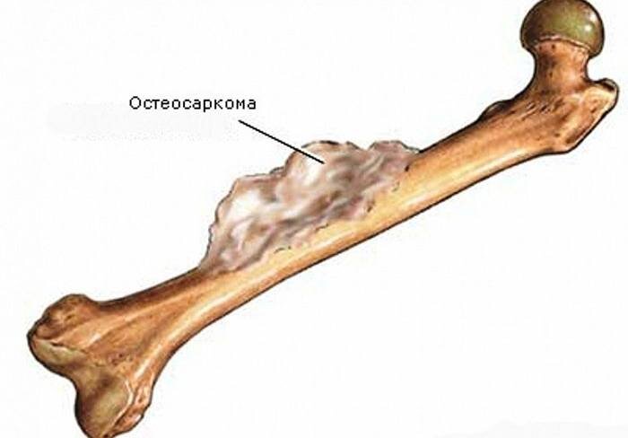 Рак кости - остеосаркома