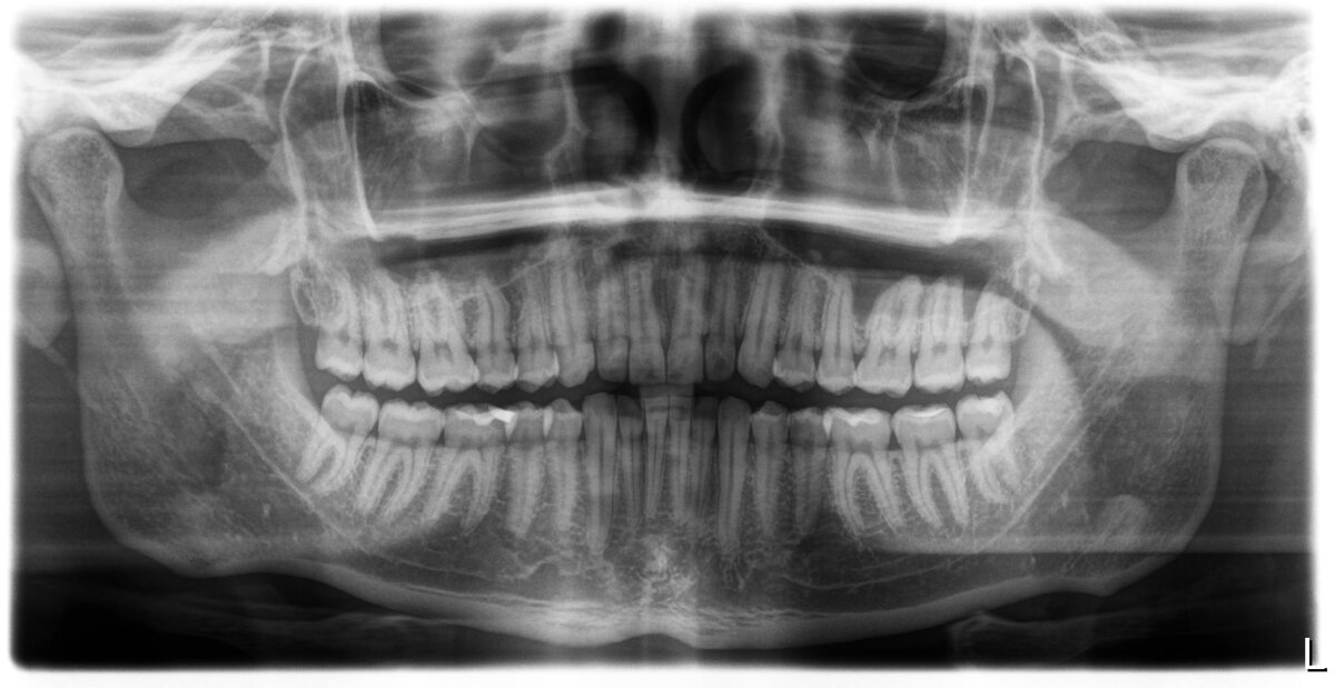 Например у этого пациента все четыре зуба мудрости прорезались правильно и даже в полости рта стоят ровно