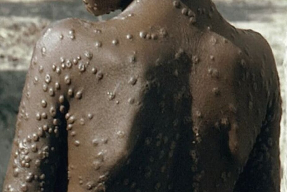 симптомы оспы обезьян: сыпь на коже