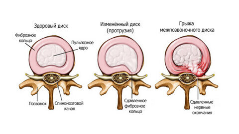 Что делать при износе межпозвоночных дисков?