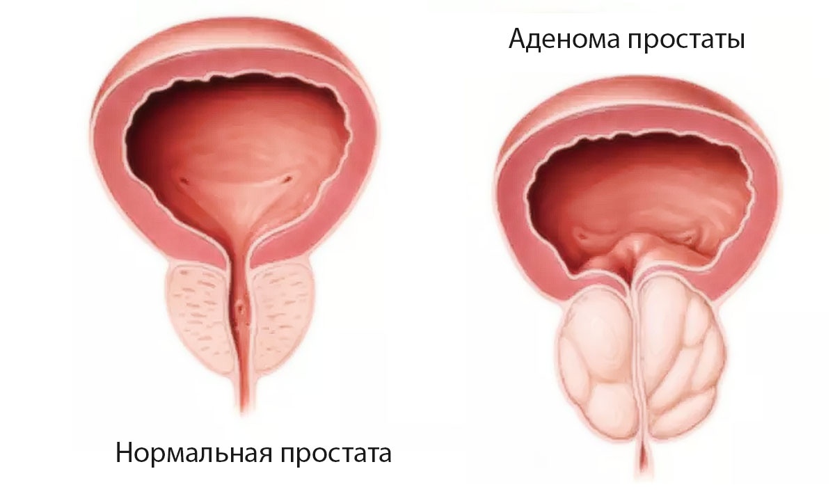 Мы видим: 1. увеличение и разрастание тканей предстательной железы; 2. деформацию мочевого пузыря; 3. обструкцию (сужение, сдавление мочеиспускательного канала - уретры). 