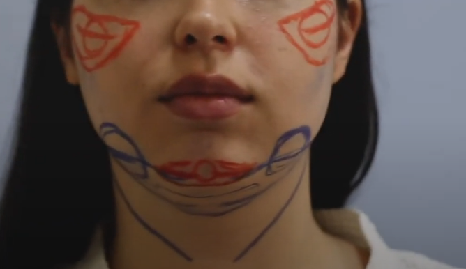 Подготовка к липосакции подбородка 