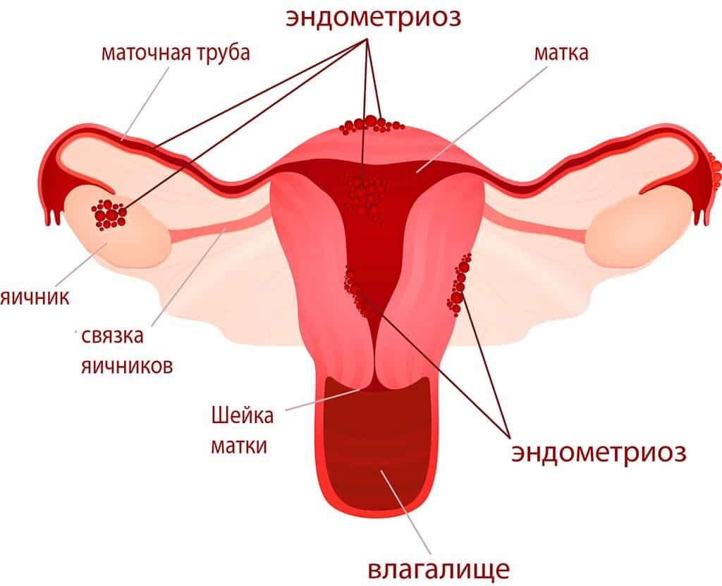 Эндометриоз — откуда берется самая загадочная женская болезнь | Evolutis  Clinic | Дзен