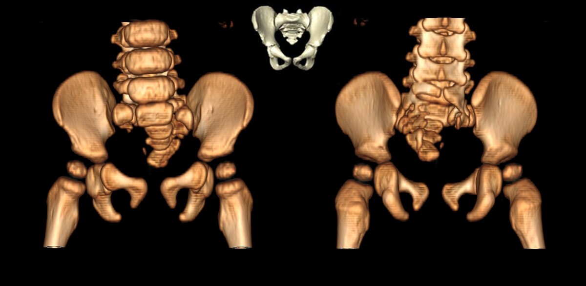 3d компьютерная томография ребенка с LUMBAR-синдромом. На изображении видна деформация костей таза, недоразвитие и деформация костей крестца. Клинический материал Центра сосудистой патологии "Гемангиома".