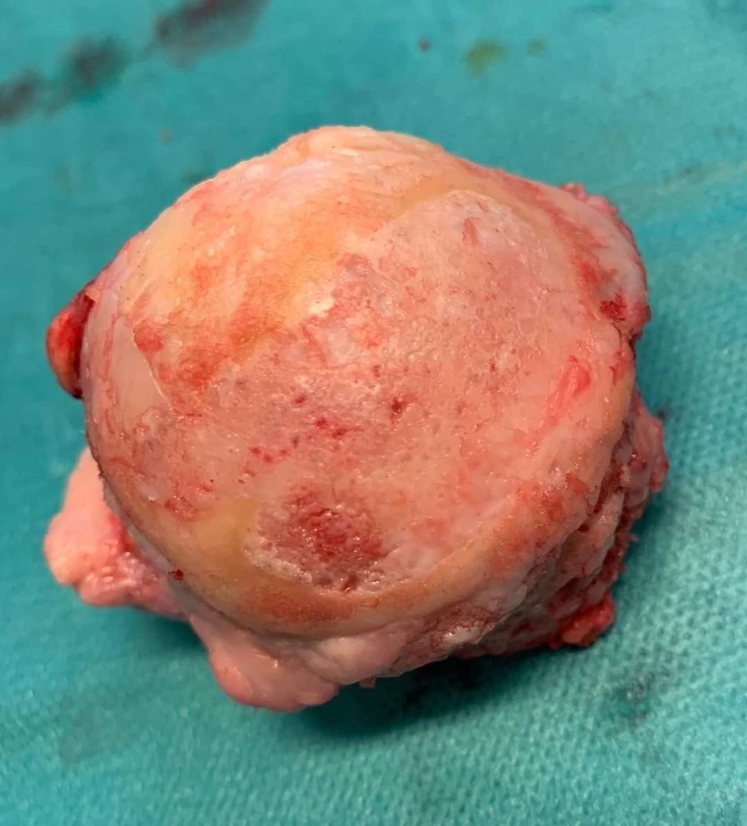 В карусели фото головки бедренной кости после извлечения.