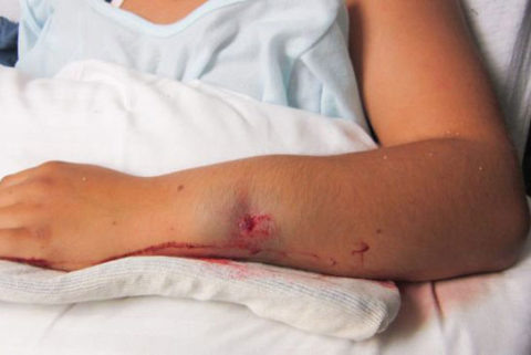  Первая цель ЛФК – ускорить исчезновение отёчности и гематомы