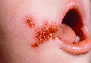 Как лечить золотистый стафилококк в горле у ребенка