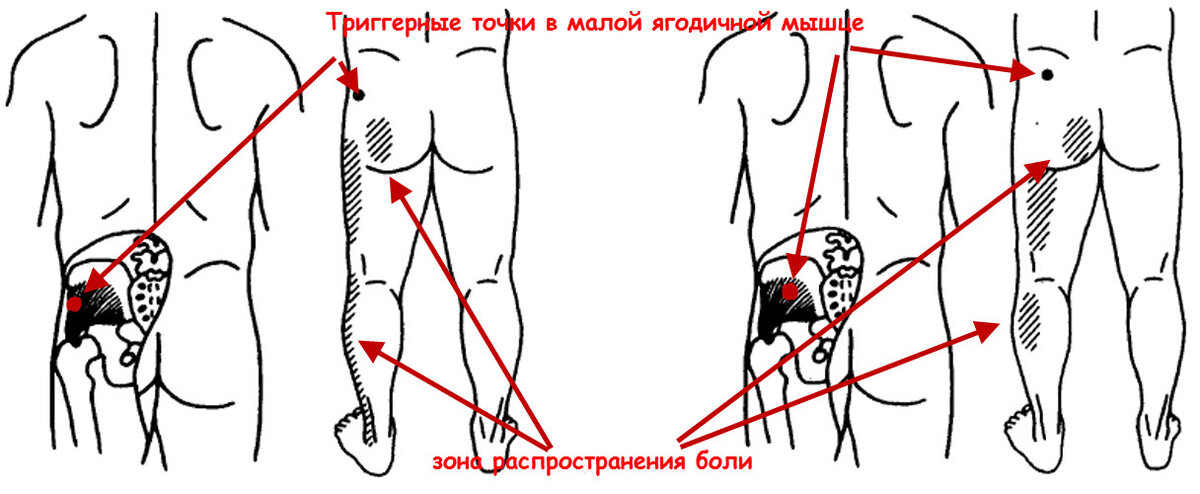 Боль поясница слева отдает в ногу. Триггерные точки ягодичной мышцы.