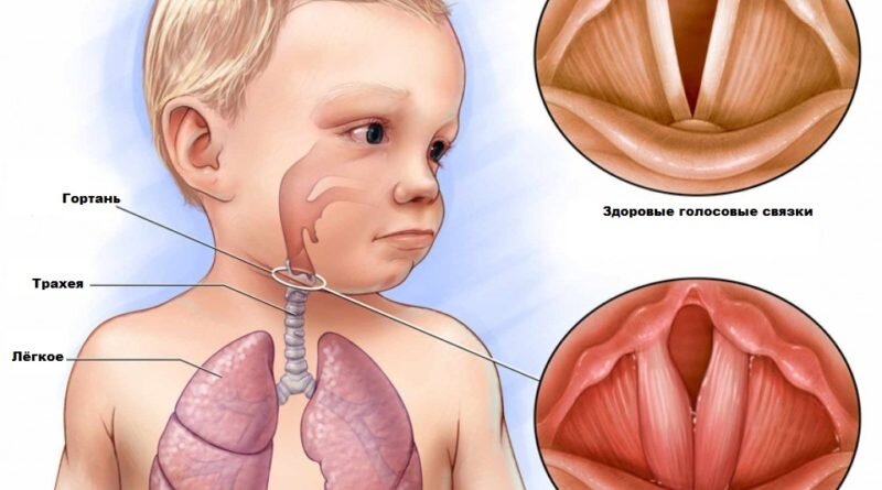 Ларингит у детей - симптомы, признаки, диагностика, лечение и профилактика