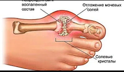отложение мочевых солей