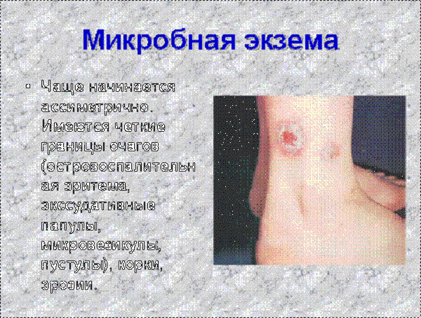 Микробная экзема