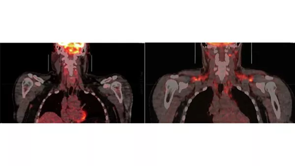 Слева: неактивный бурый жир. Справа: бурый жир, активированный охлаждением (оранжевые зоны в районе плеч и шеи).