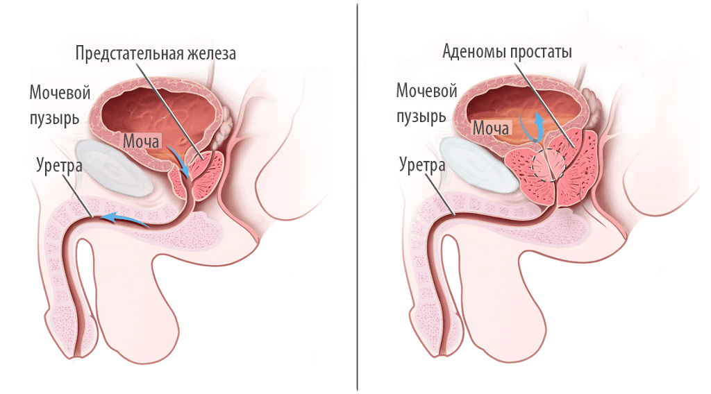 Аденома простаты схема