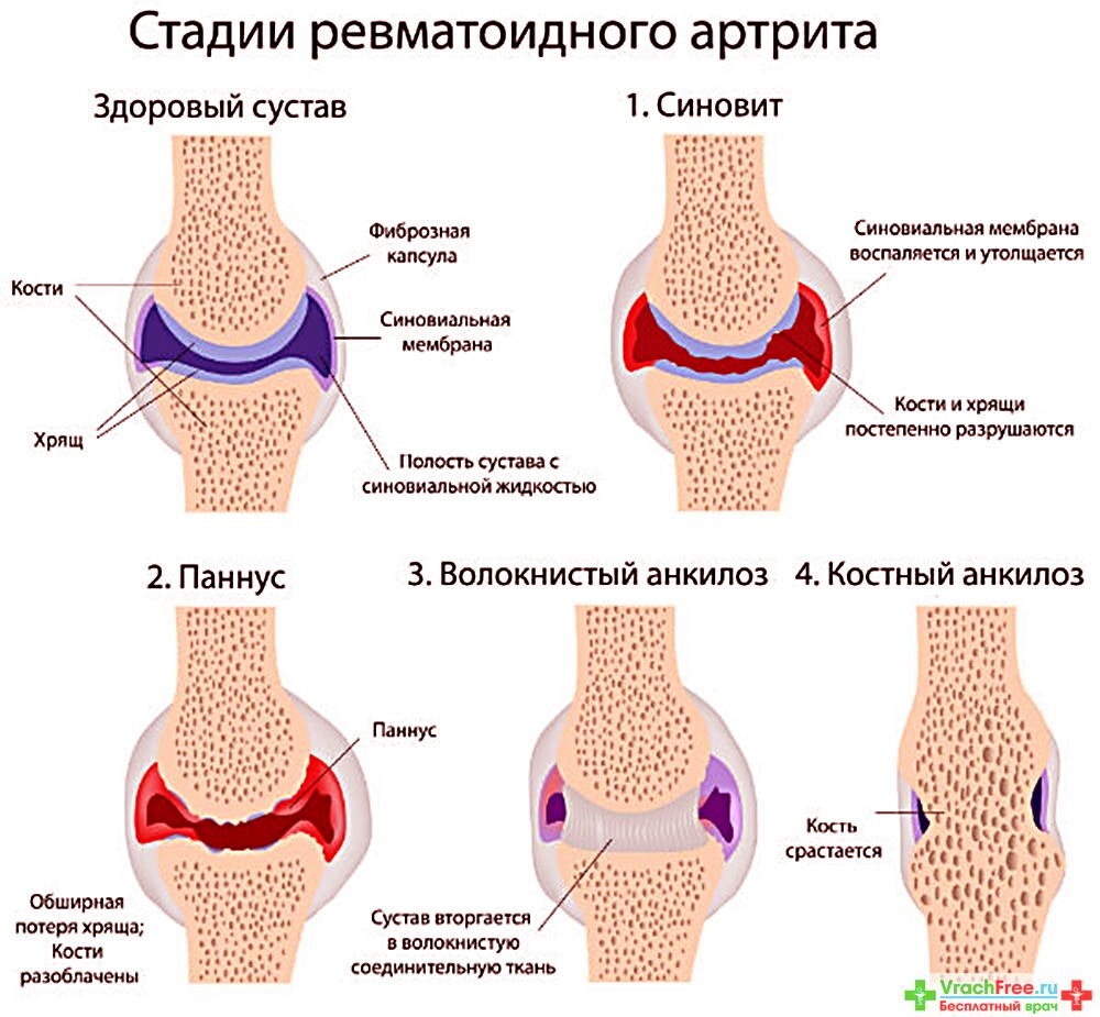 Паннус ревматоидный артрит. Микропрепарат ревматоидный паннус. Ревматоидный артрит 4 степени.