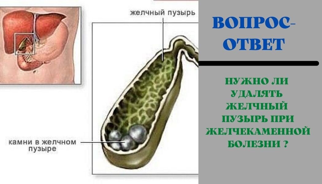 ЖКБ конкременты желчного пузыря. Желчекаменная болезнь холелитиаз. Желчный пузырь желчнокаменная болезнь. Желчнокаменная болезнь (холелитиаз). Удалили желчный пузырь как жить