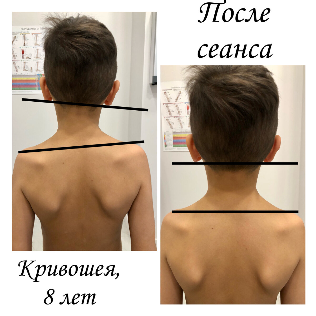 Костя кривошея. Дети кривошеи. Костя кривошея. Krivasheya. Кефалогематома кривошея.