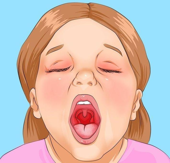Не открывается рот болит. Скарлатина фарингоскопия. Больное горлышко у ребенка.