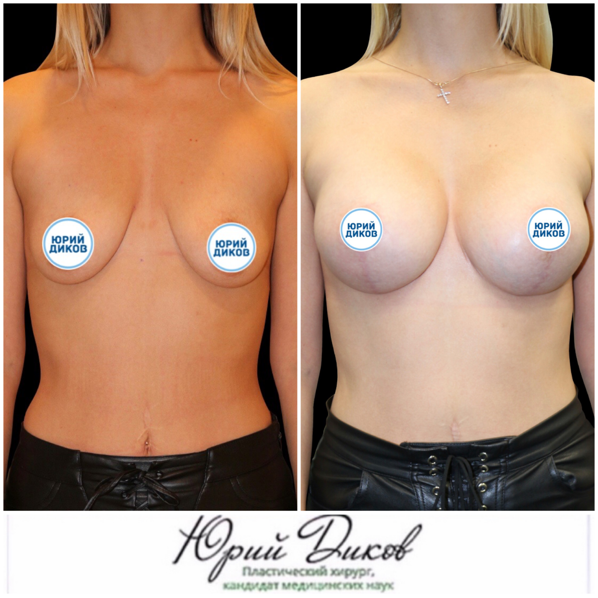 1500cc breast implants