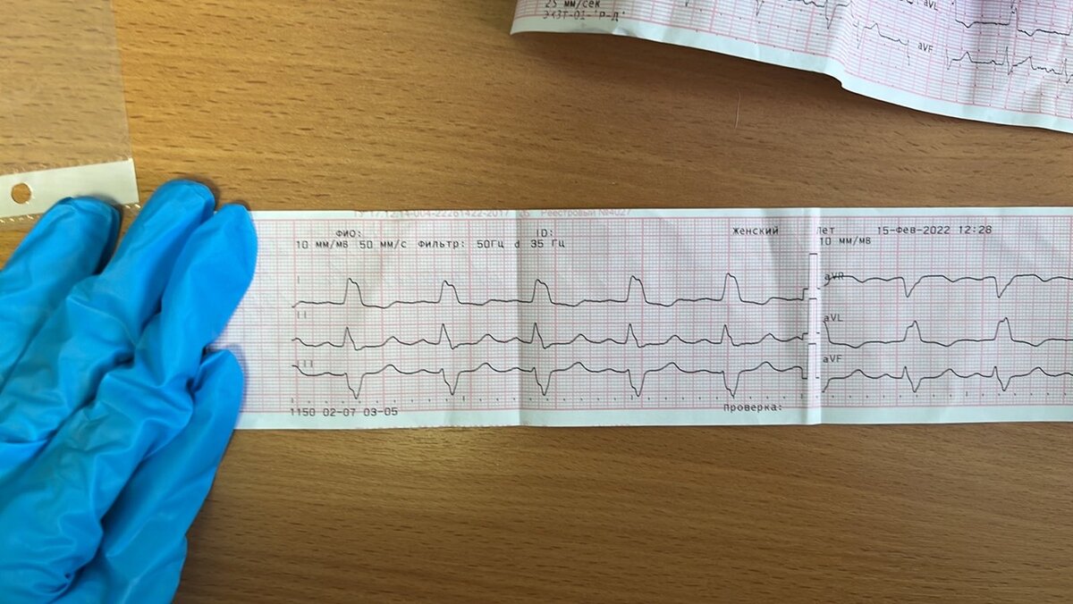 ЭКГ пациентки 1.Фото сделы автором.