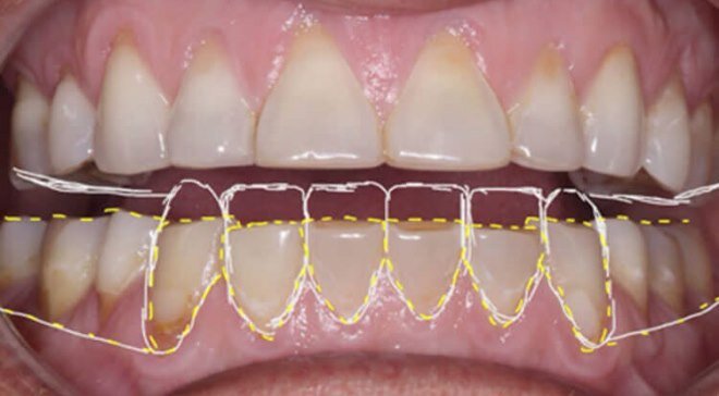 Повышенная стираемость зубов и клиновидные дефекты в пришеечной областях. Фото из открытого источника Яндекс-картинки