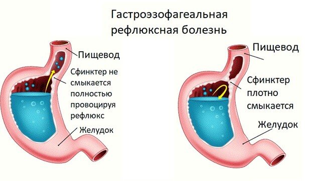 Боли в животе у детей