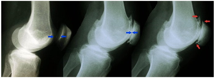 
Рентгенограммы здорового коленного сустава (слева) и сустава при гонартрозе бедренно-надколенникового сочленения. Среднее изображение показывает потерю суставной щели. На правом изображении выделяются образующиеся костные заострения или шпоры.