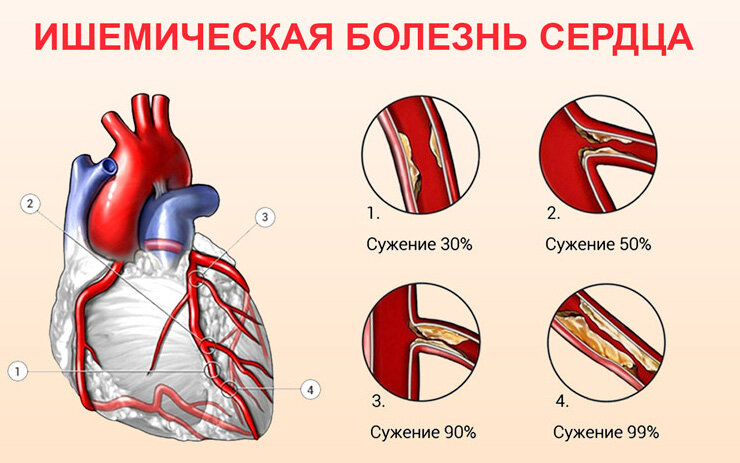 Большая часть болезней, ограничивающих активность человека и участие в социальной жизни, принадлежит к сердечно-сосудистым нарушениям.