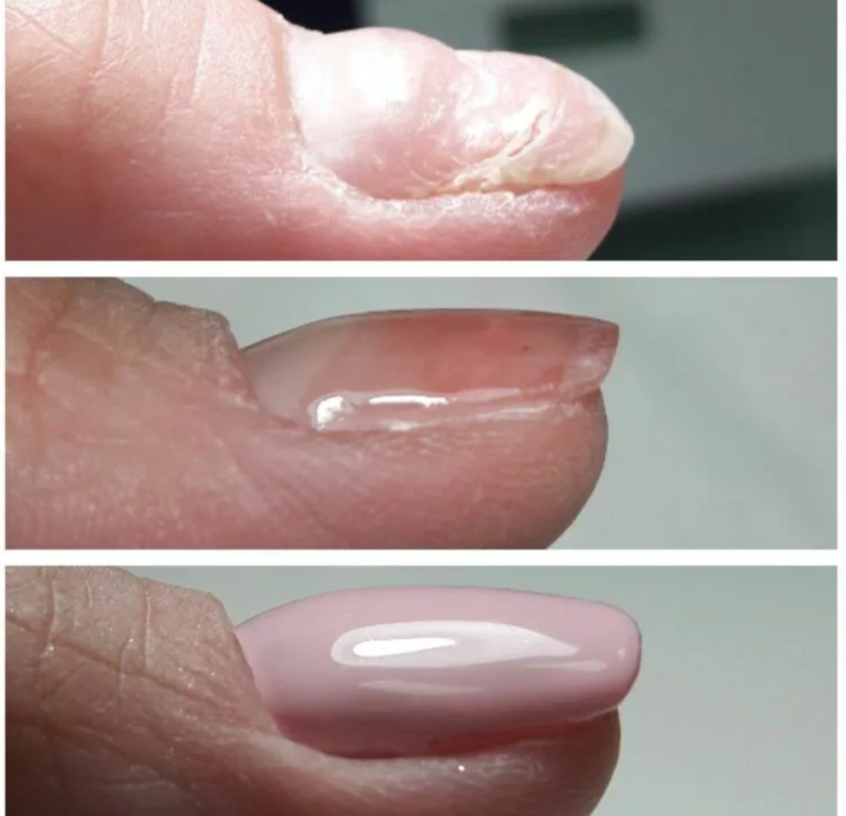 Портит разбор. Выравнивание ногтевой пластины. Восстановление ногтейвой плсат.