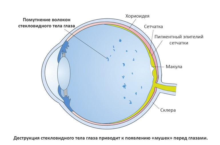 Лечение мушек перед глазами