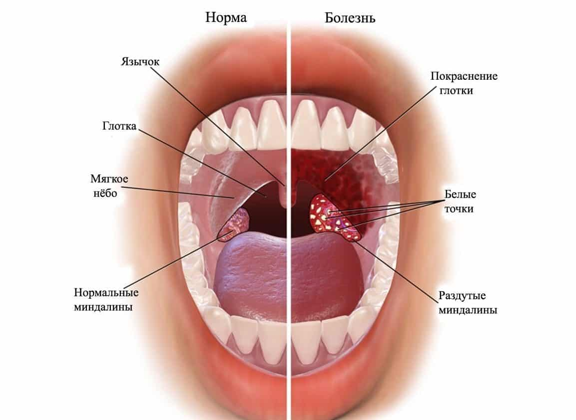 Почему болит горло и как его лечить?: статьи клиники Оксфорд Медикал Киев