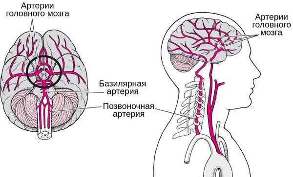 Вертебробазилярный инсульт. Асимметрия передних мозговых артерий. Сосудистая асимметрия. Синдром Барре-Льеу (шейная мигрень). Гипоплазия правой артерии головного мозга