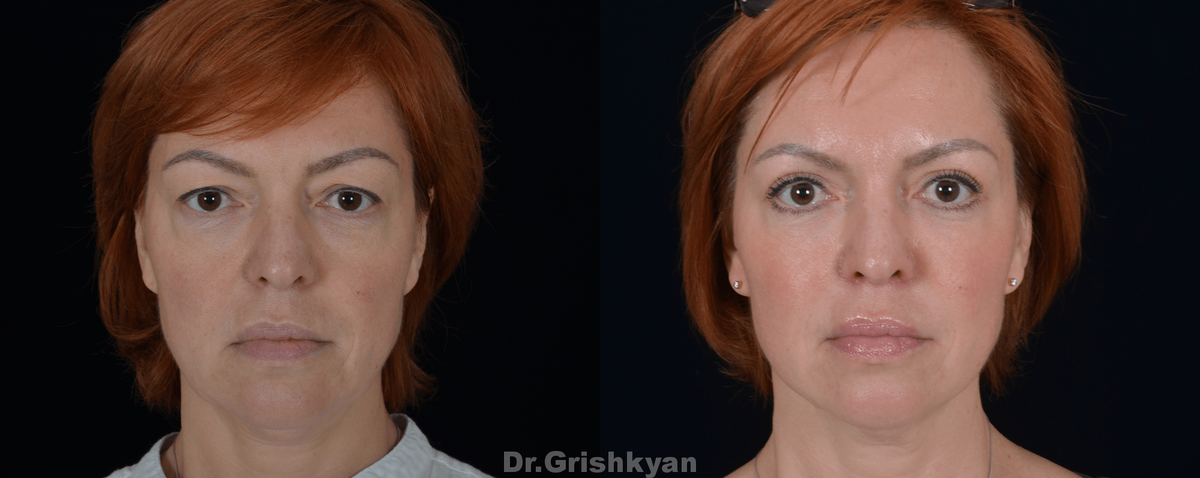 Липофилинг лица и пластика верхних век фото до и после. Фото с сайта Д.Р. Гришкяна. Имеются противопоказания, требуется консультация специалиста