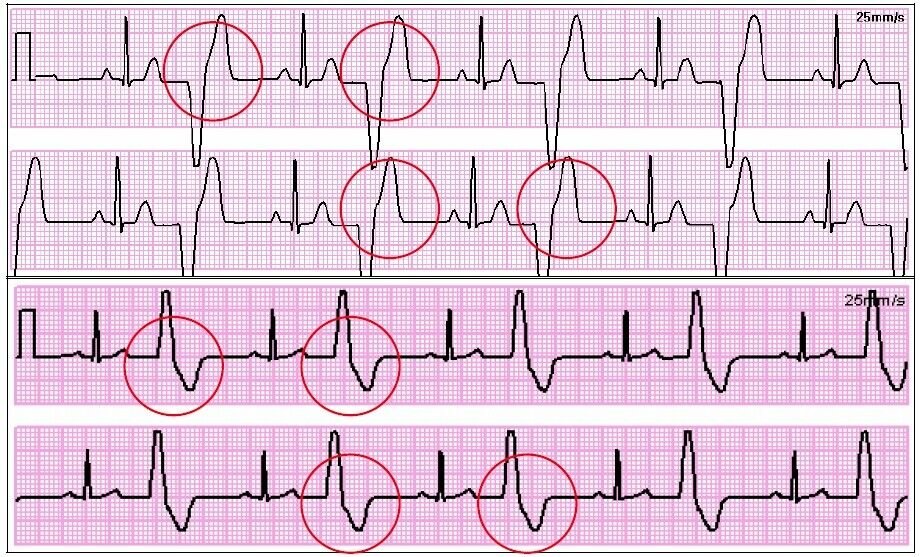 Частые желудочковые экстрасистолы карта вызова