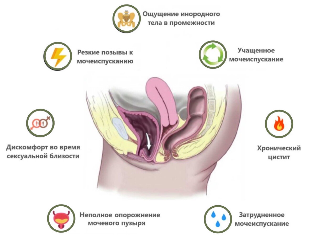 Опущен е. Пролапс передней стенки мочевого пузыря.