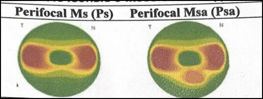 Perifocal - первые дефокусные линзы для контроля роста глаза в длину