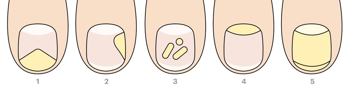 Фотографии работ по медицинскому педикюру Nail Clinic