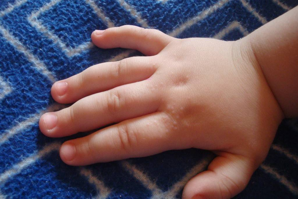 Детская сыпь на теле у ребенка