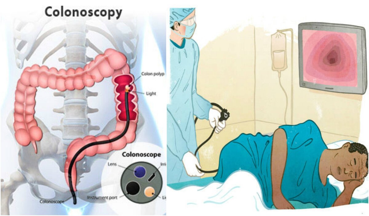 Колоноскопия с наркозом или без? Как лучше? | Тулина Инна Андреевна | Дзен