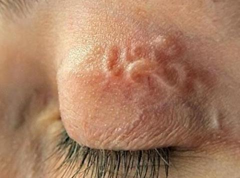 Дирофиляриоз глаза