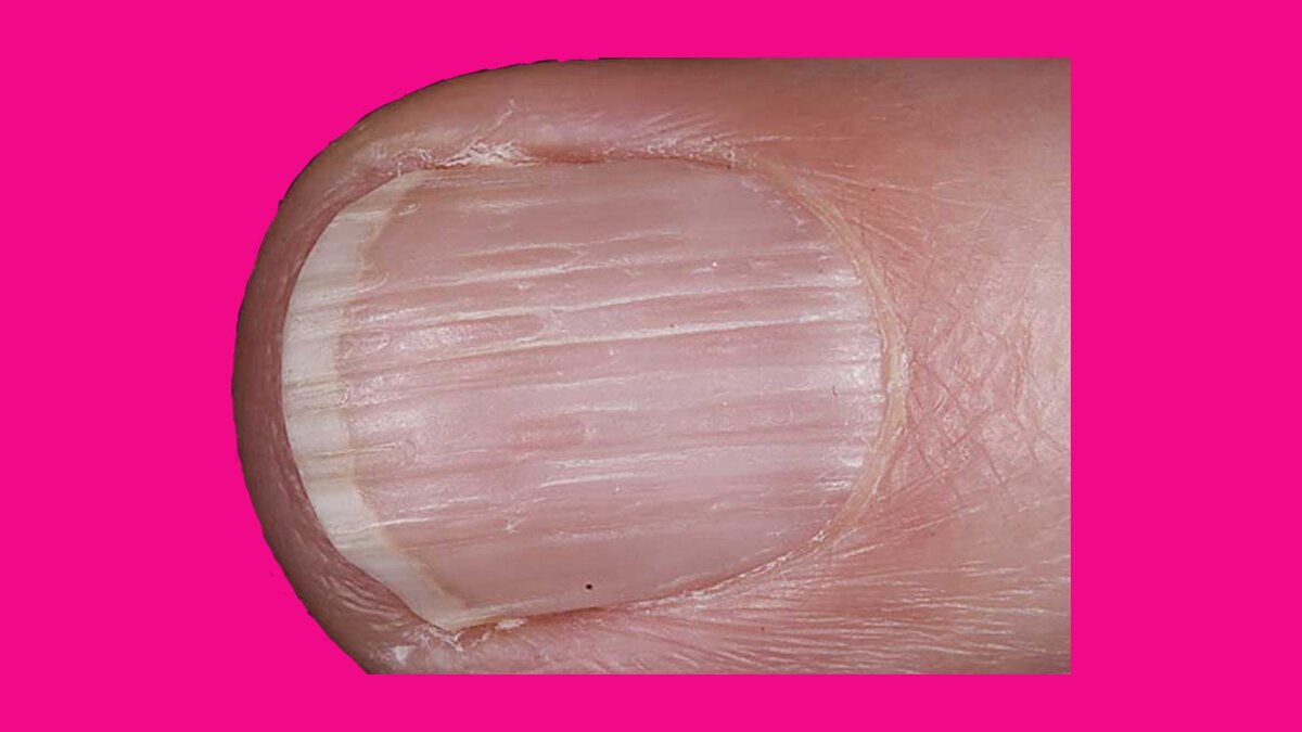 Продольные полосы на ногте.