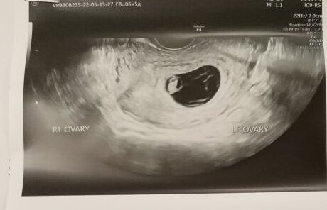 Результаты первого УЗИ