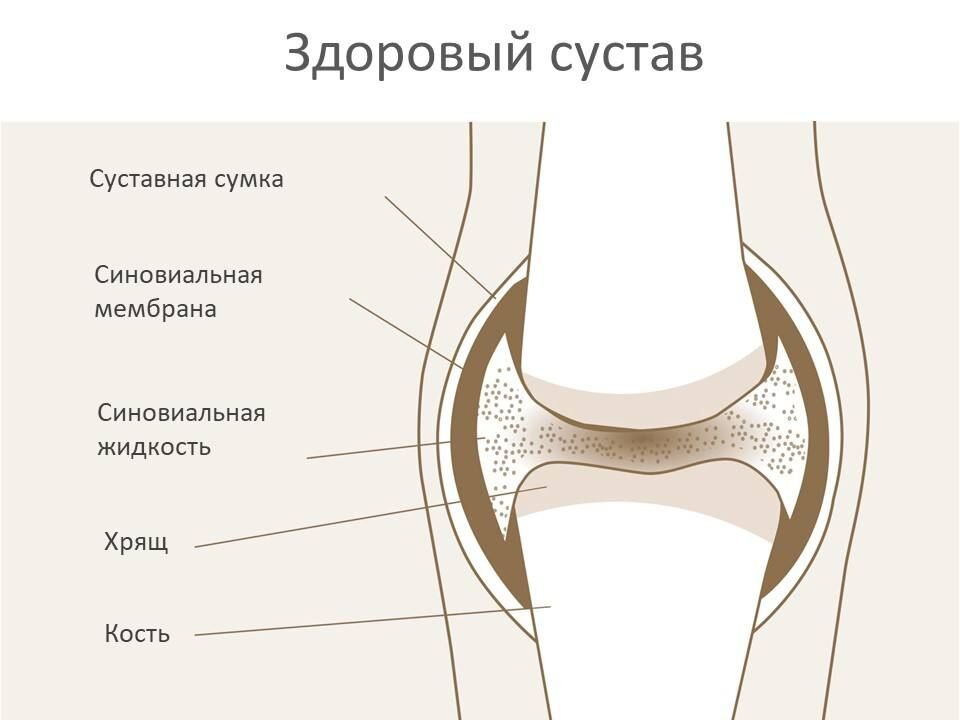 состоит из гликозаминогликанов, гиалуроновой кислоты, хондроитин сульфата и воды. Именно из нее клетки хряща получают нужные им питательные вещества и отдают продукты обмена.‼️И именно от качественного состава суставной жидкости будет зависеть питание, а значит, и здоровье, подвижность суставов.В возрасте 40 лет🍀 образование собственной гиалуроновой кислоты уменьшается на 50%. В 60 лет и далее организм производит только 10% от ее необходимого количества.‼️Гиалуроновая кислота – больше чем просто «суставная жидкость»‼️Гиалуроновая кислота содержится во многих тканях человеческого организма: хрящи, кости, стекловидное тело, сердечные клапаны, кожа, синовиальная жидкость. Она натягивает кожу и кожные связки, эластично поддерживает хрящ и смазывает наши суставы, является основной составляющей синовиальной (или суставной) жидкости. Без этой жидкости не работали бы наши суставы.Гиалуроновая кислота способна связывать и удерживать до шести литров воды на грамм. Воду нельзя сжать. Это свойство гиалуроновая кислота передает суставам. Она отвечает за консистенцию жидкости в тканях и изменяет ее вязкость.Хондроитин – «эластическое чудо»‼️Хондроитин – важная составляющая хряща. Хондроитин мы частично употребляем с пищей, а частично он синтезируется в организме сам. Его биоактивной формой является хондроитин сульфат.Хондроитин сульфат – это магнит для жидкости. Он обеспечивает эластичность и амортизирующие функции суставного хряща.🍀Гиалуроновая кислота и хондроитин гораздо лучше защищают суставы совместно. 🍀Если эти вещества поступают  одновременно, они действует синергично, то есть взаимно дополняют друг друга в защите и питании хрящевых тканей и действуют несравнимо более эффективно, чем каждый в отдельности.Что делать, если осложнения уже наступили и вашим суставам необходима поддержка?  Восполнить дефицит гиалуроновой кислоты в организме возможно! 👌