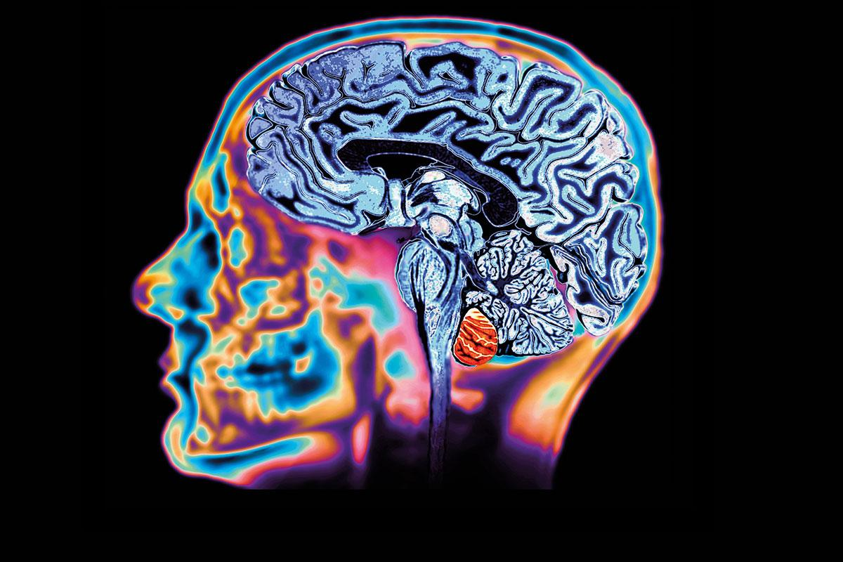 Снимки мозга. Томография мозга. Магнитно-резонансная томография головного мозга. Наследственное заболевание мозга