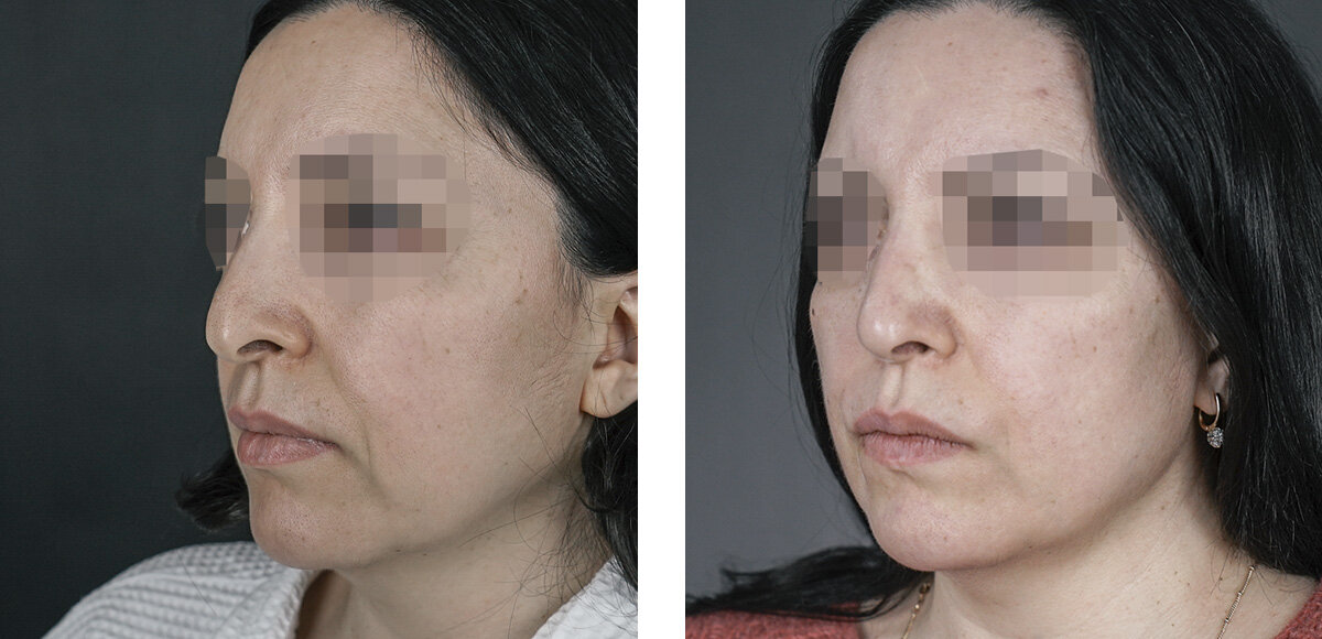 Результат риносептопластики. В данном случае я выполнял коррекцию, так как в процессе рубцевания начала расти костная горбинка. 