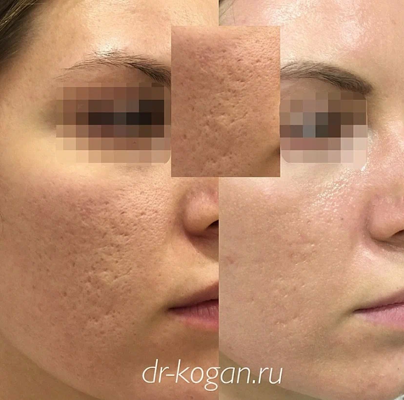 Лазерная шлифовка кожи co2 skinlift ru. Фракционная лазерная шлифовка. Лазерная шлифовка кожи со2. Фракционная шлифовка со2 лазером.