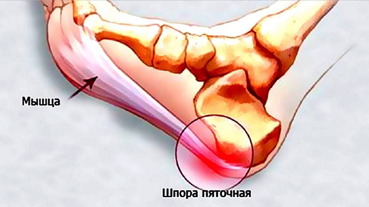 Что такое пяточная шпора картинки